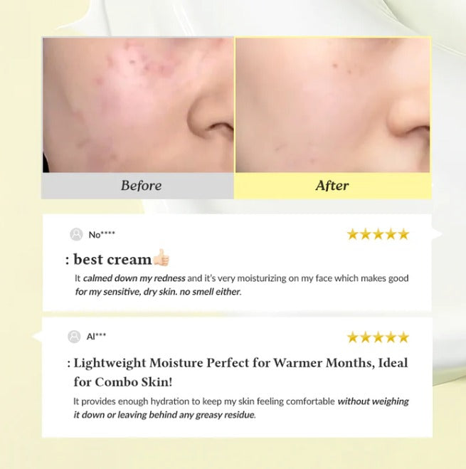 345 Relief Cream - Post acne Cream Cosmetics –