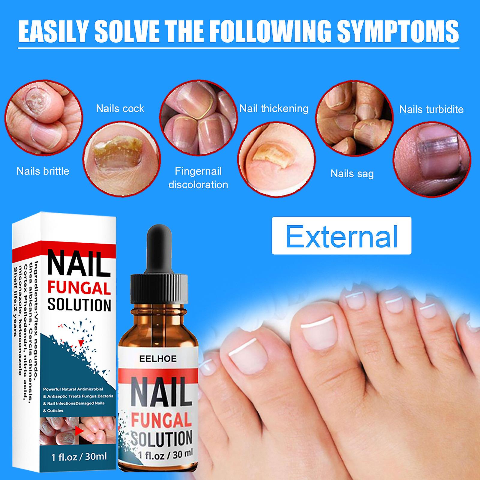 Nail Repair Liquid Hand And Foot Grey- Nail Care Repairing The Thickened Soft Nail Of Grey- Nail