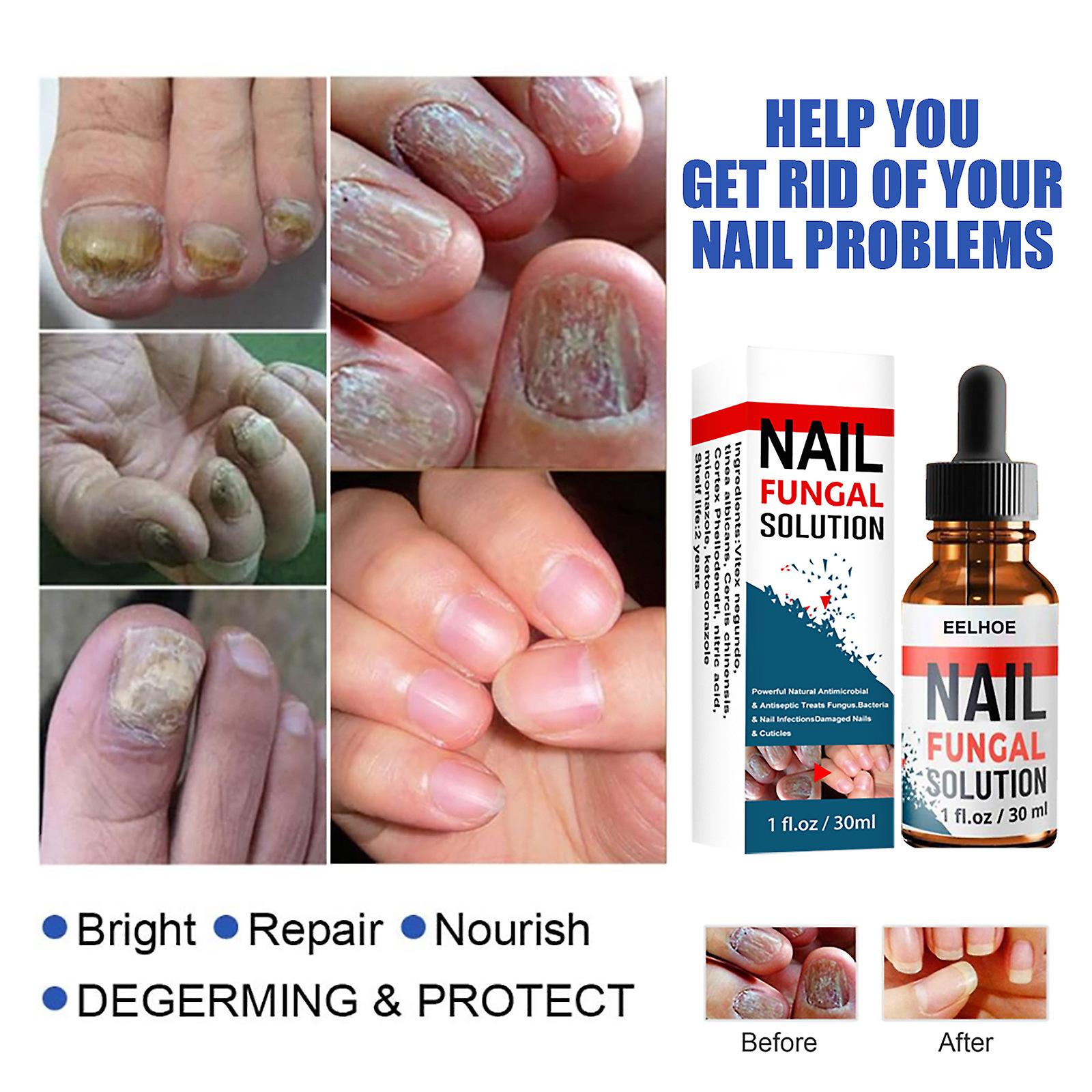 Nail Repair Liquid Hand And Foot Grey- Nail Care Repairing The Thickened Soft Nail Of Grey- Nail