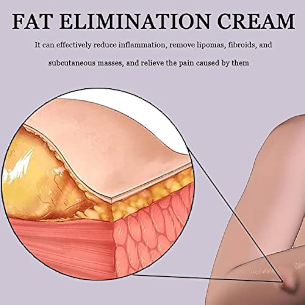 Lip removal cream cellulite removal ointment skin swelling lipolysis fat mass body hard block removal medicine 20g