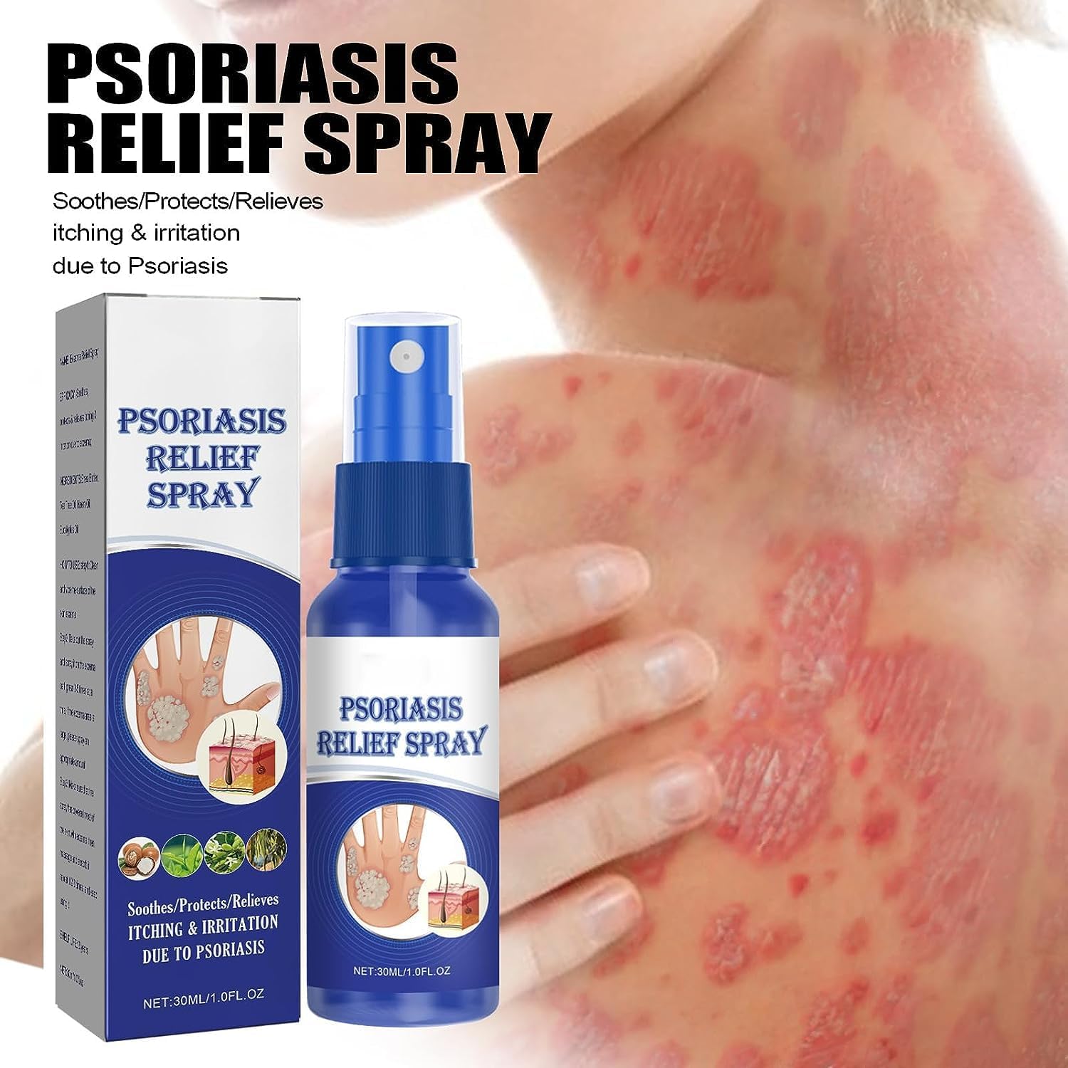 South Moon Psoriasis Repair Spray, Professional Ps South Moon Psoriasis Repair Spray, South Moon Psoriasis Relief Spray, Herbal Psoriasis Relief Spray